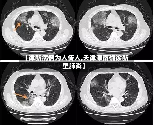 【津新病例为人传人,天津津南确诊新型肺炎】-第1张图片